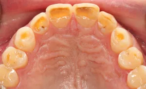 Bruxism