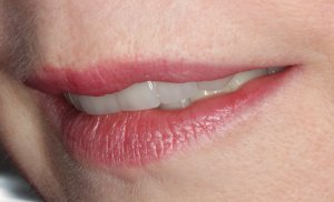 Implant Supported Restorations