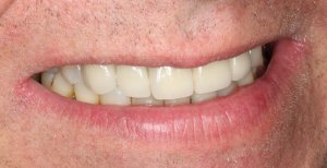 Implant Supported Restorations