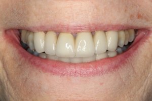 After Treatment image