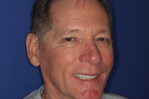 An older male with a brand new smile after dental implant supported restorations