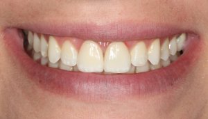 A brand new un-cracked front tooth thanks to dental crowns