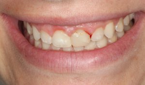 a cracked tooth in need of replacement