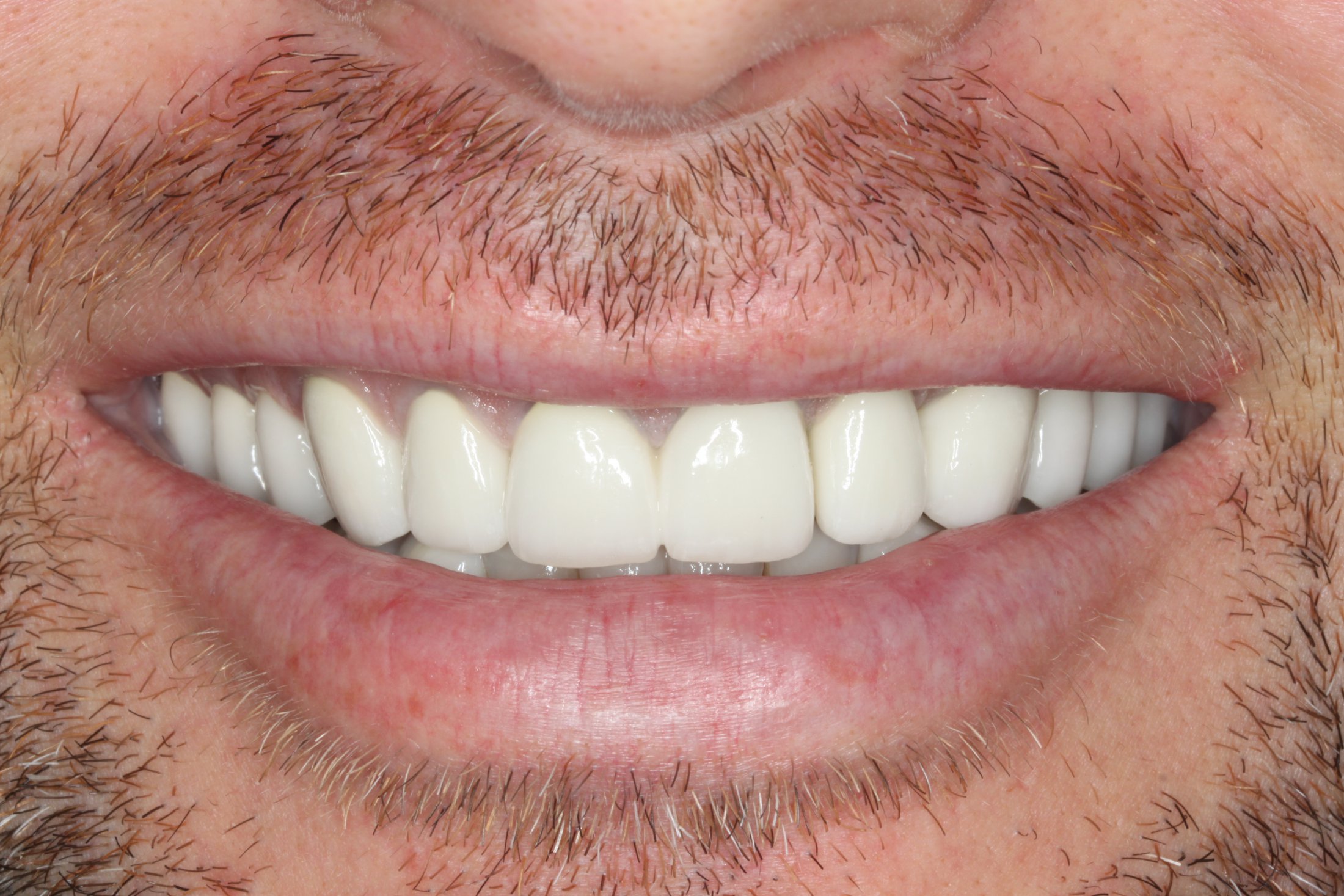 a smile after full mouth reconstruction with perfect looking teeth