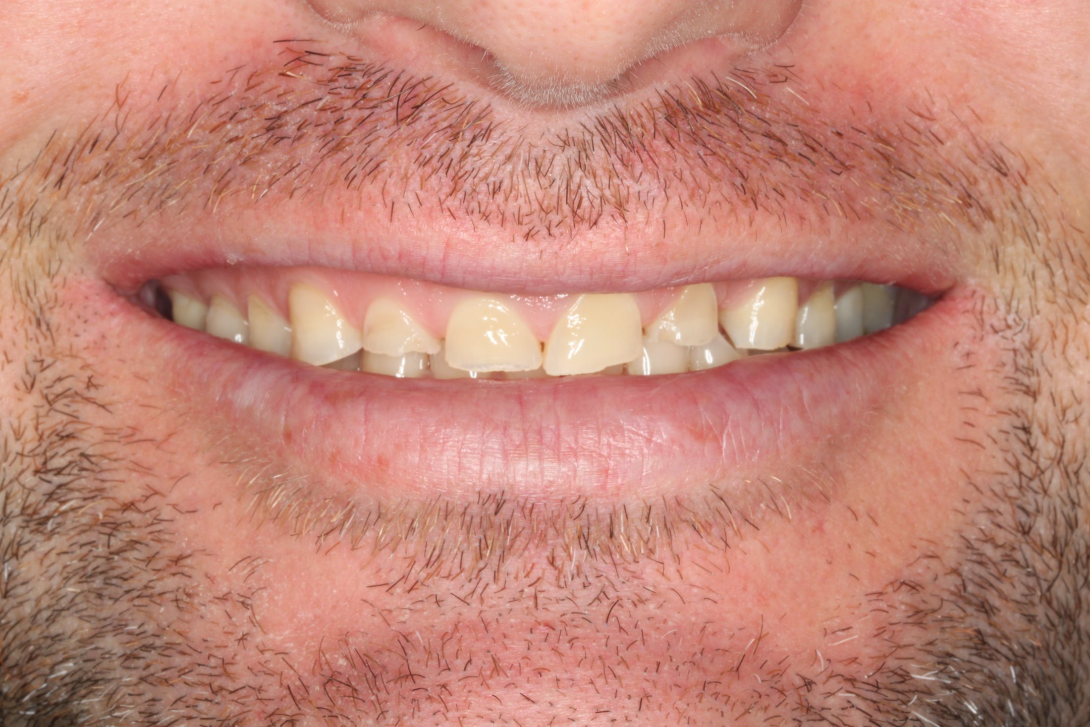 a smile of small chipped teeth before full mouth reconstruction
