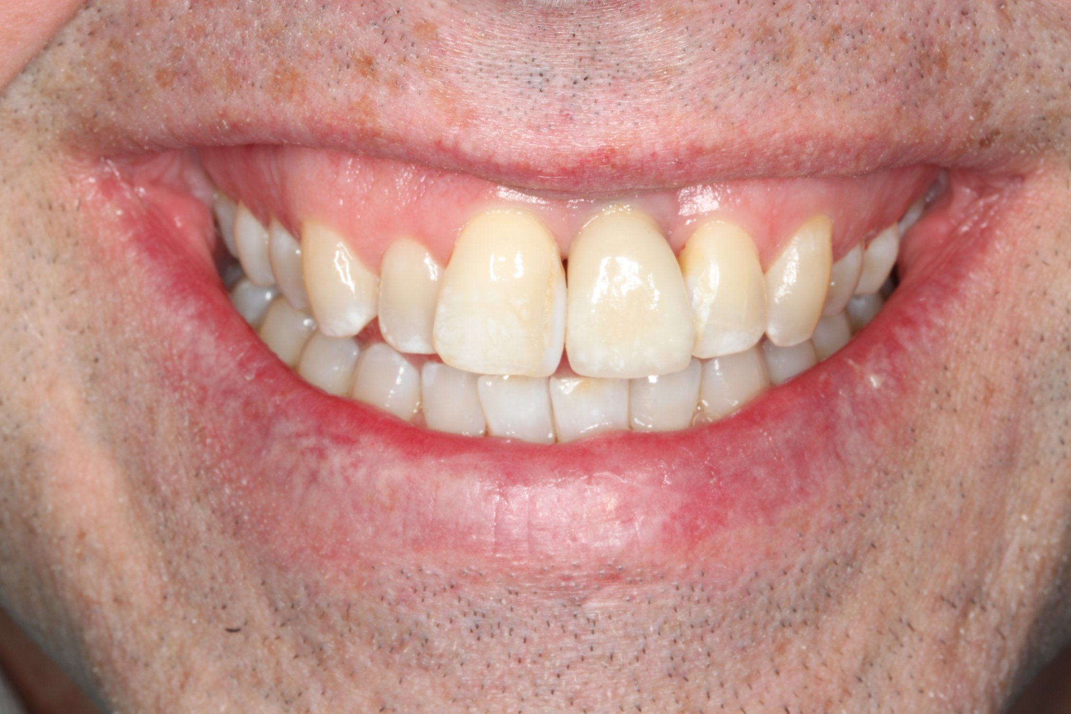 A brand new even smile after replacement of front tooth with implant supported ceramic crowns