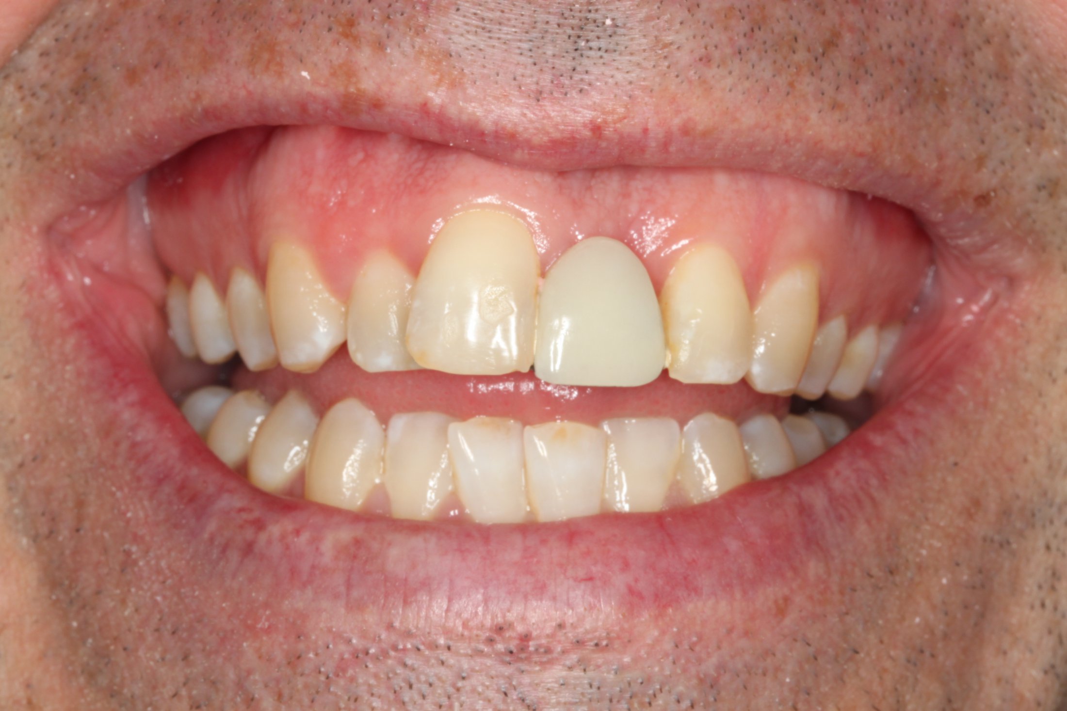 An uneven smile before replacement of front tooth with implant supported ceramic crowns