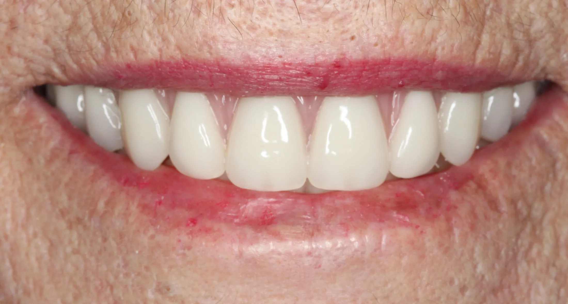 a beautiful smile with no roots showing after an implant prosthesis