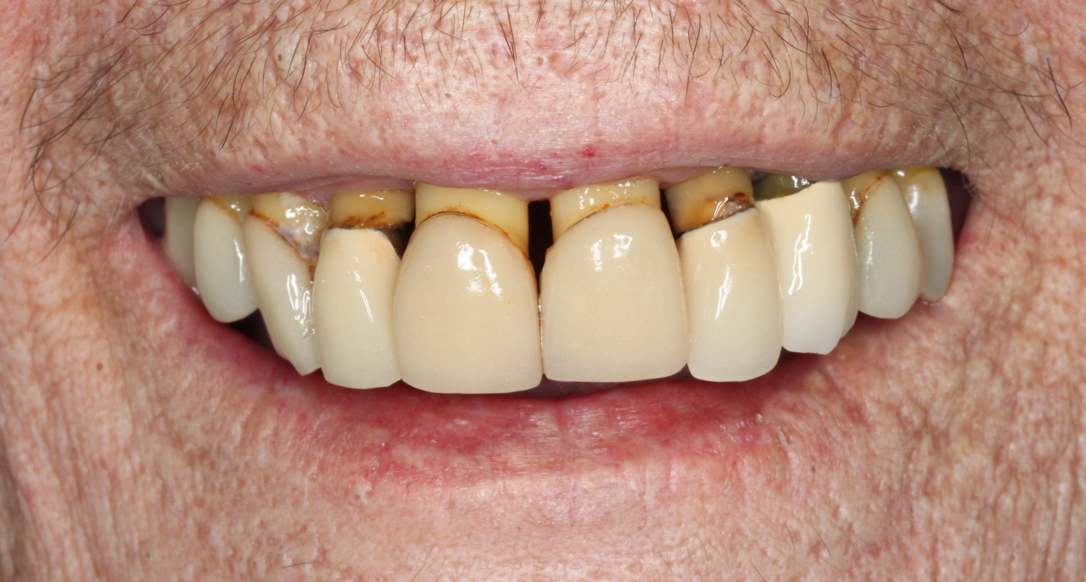 A smile with the roots of all the upper teeth showing