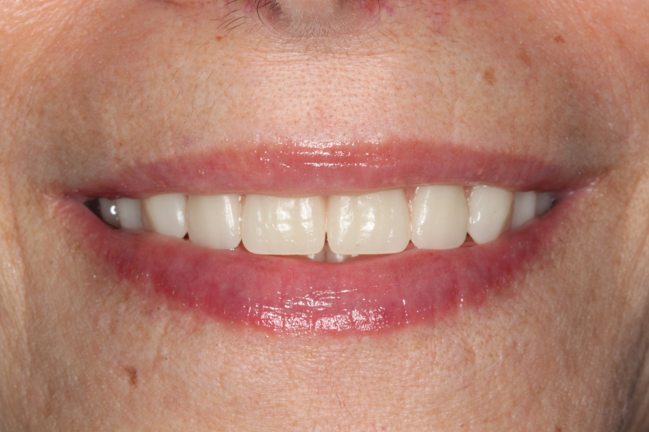 a brand new smile due to an implant supported fixed prosthesis