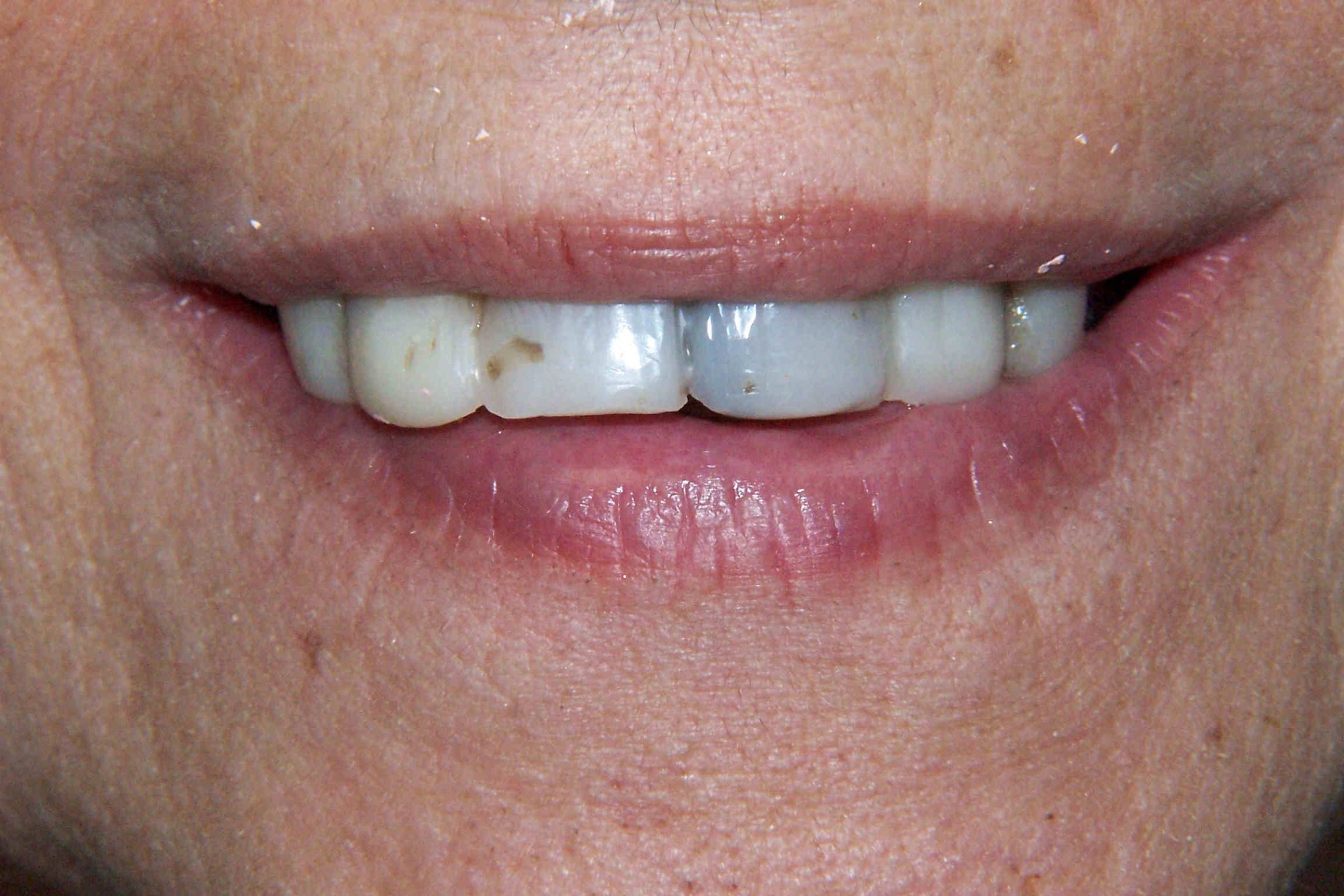 large damaged teeth