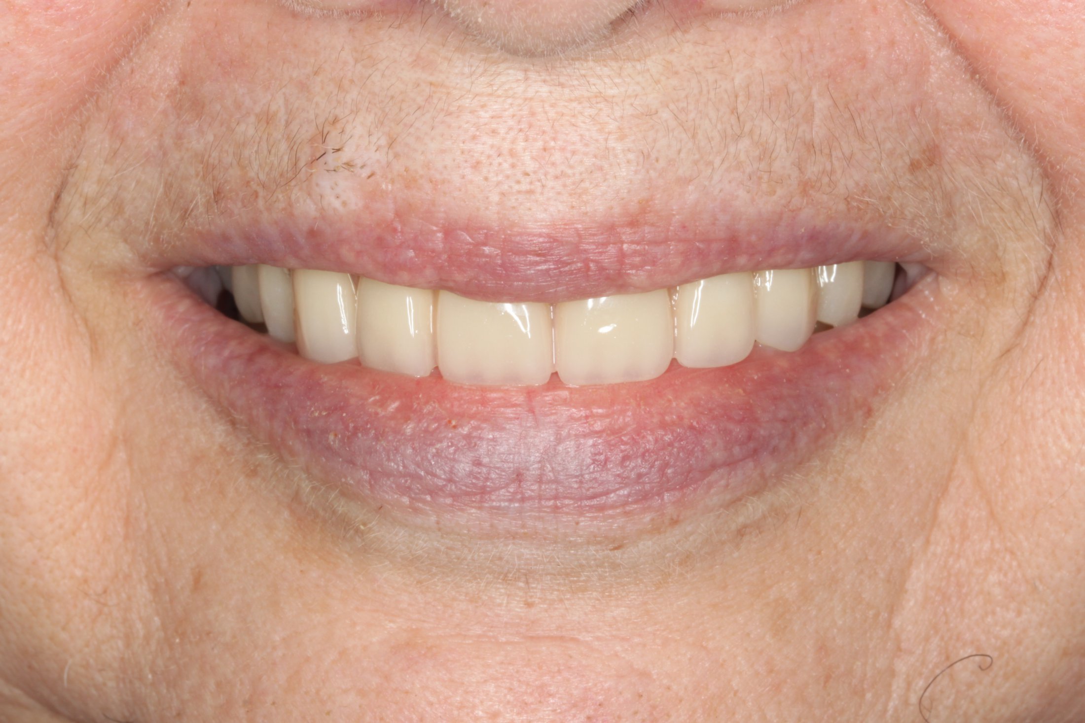 The decayed teeth have been replaced with an implant supported prosthesis, totally transforming the smile