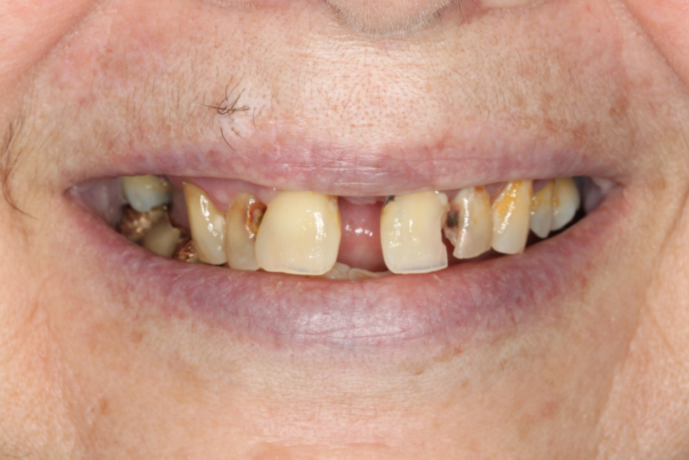 A smile with missing and decayed teeth