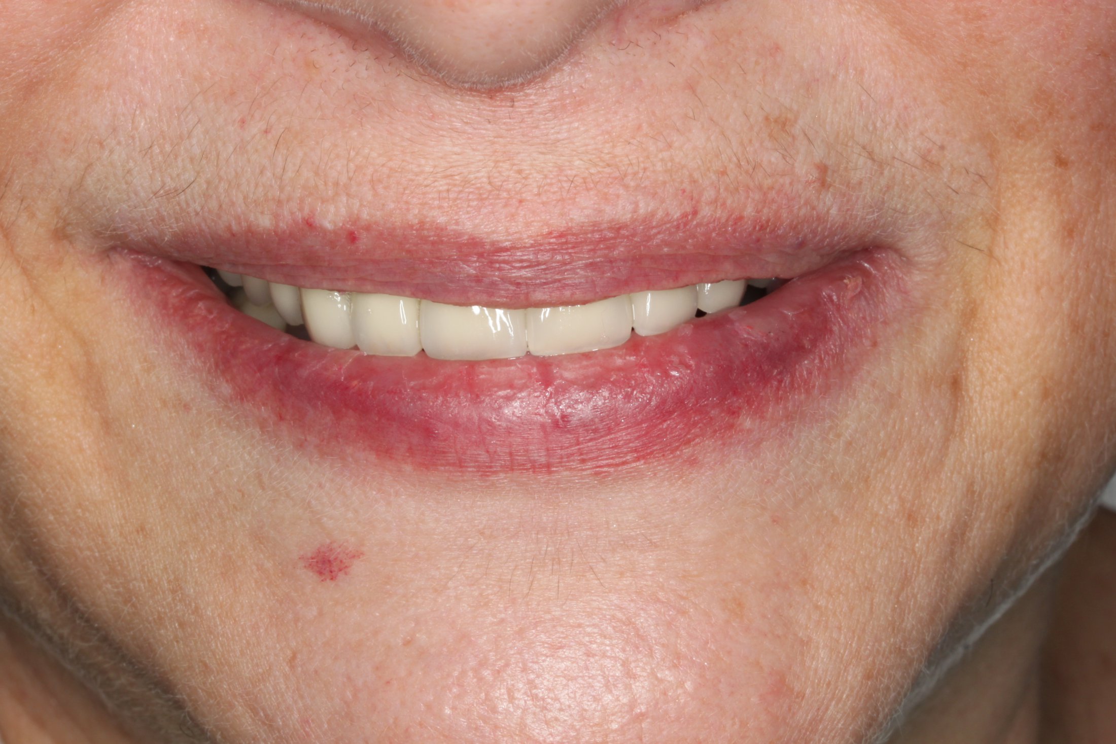 a new straight smile after maxillary arch reconstruction