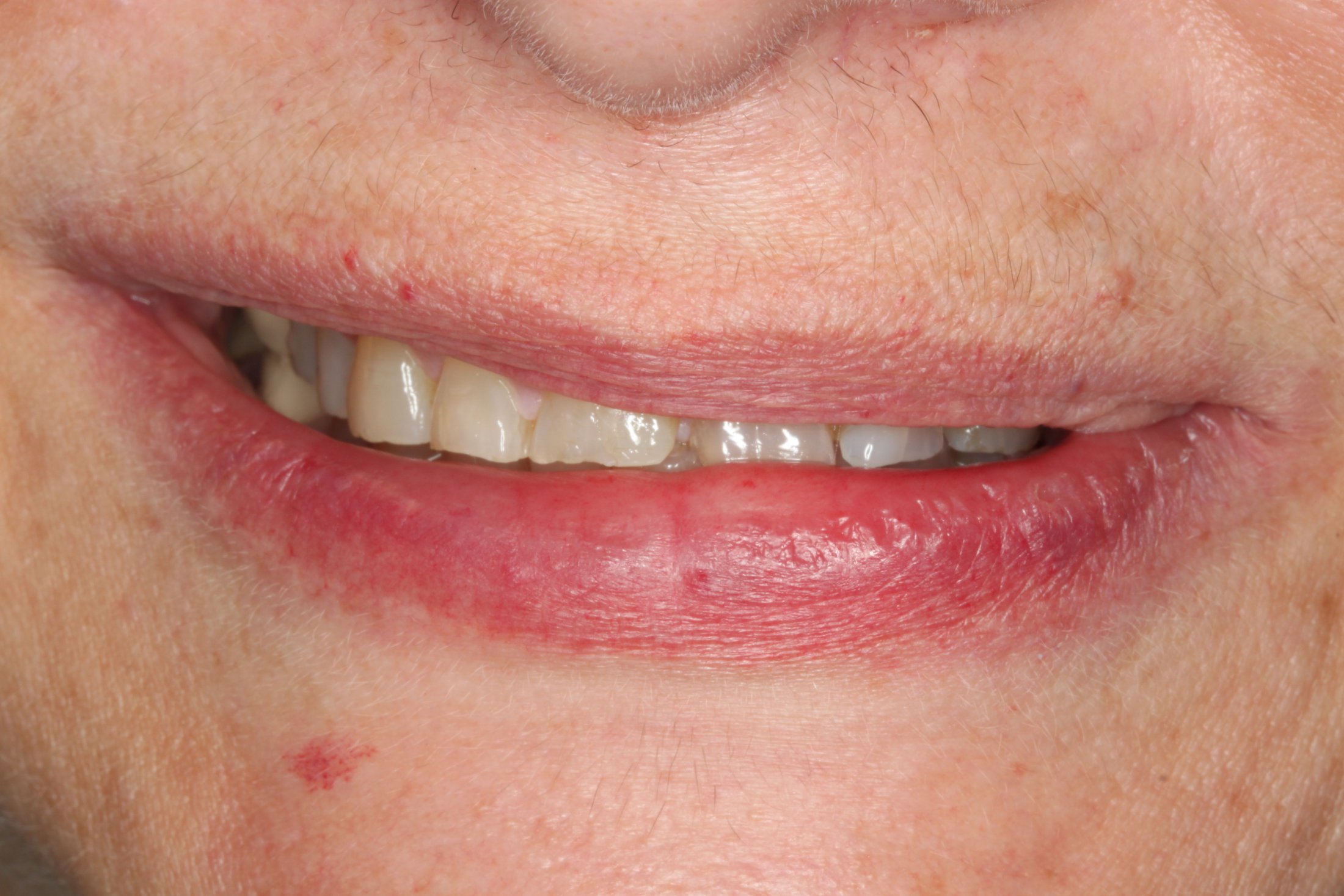 a crooked smile before maxillary arch reconstruction