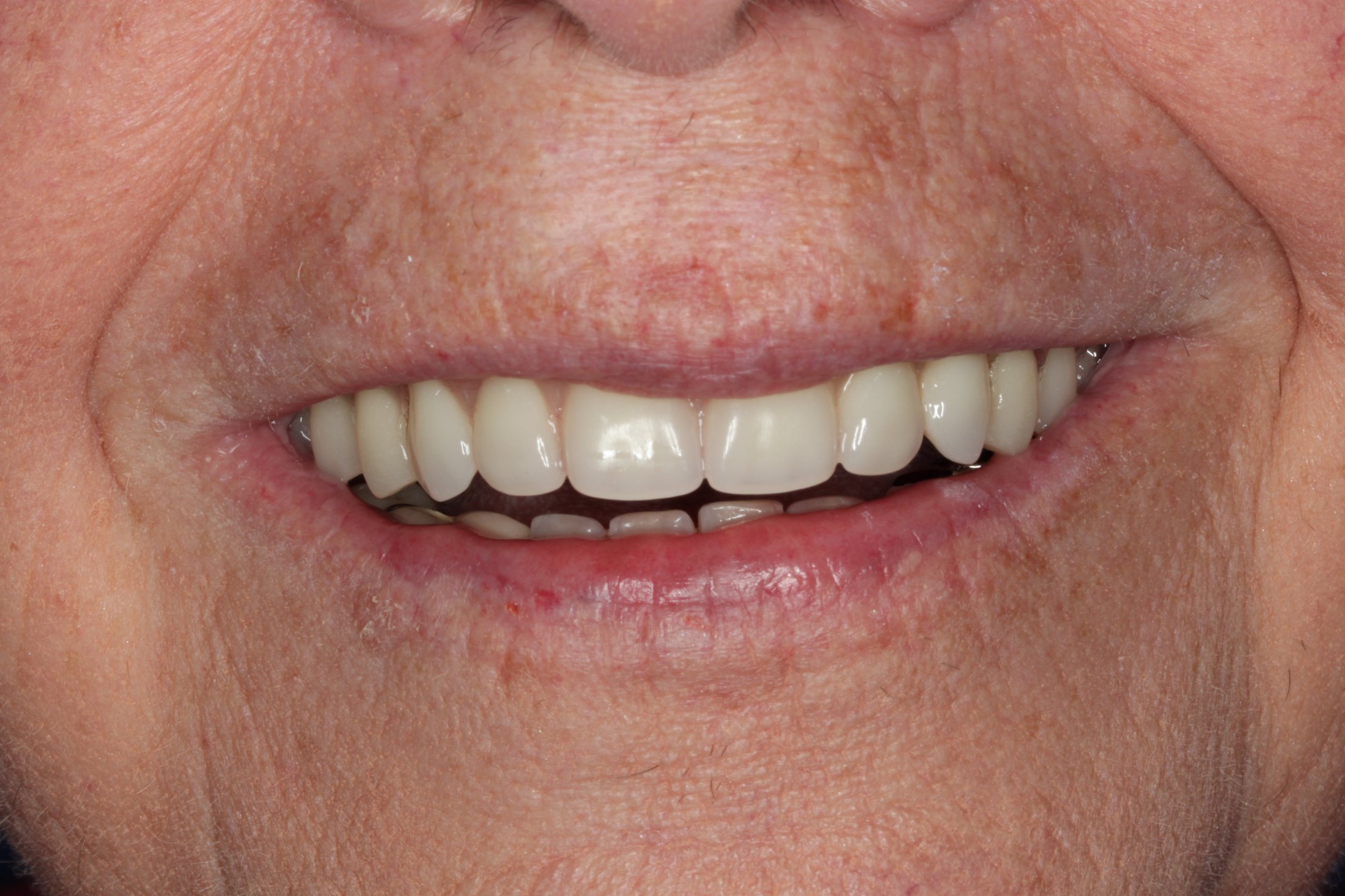 A brand new smile after maxillary denture