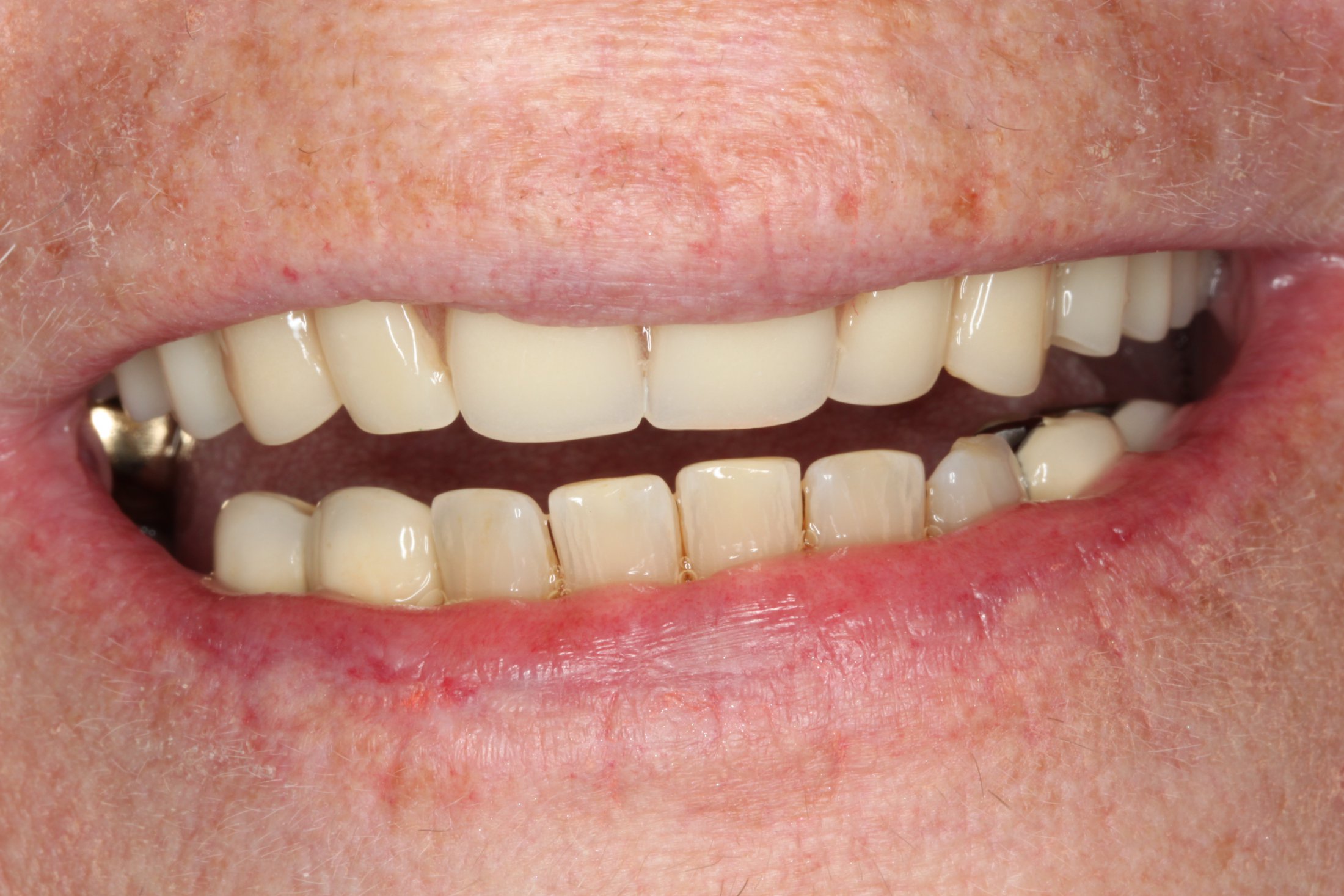 Teeth with fillings before a maxillary denture
