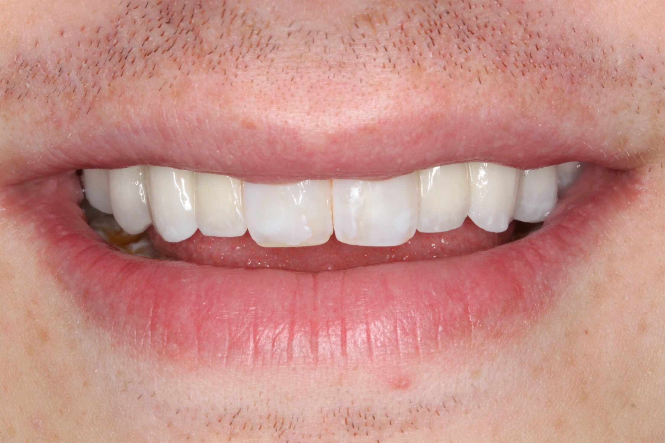 a beautiful new smile without oligodontia after Implant Supported Fixed Prostheses