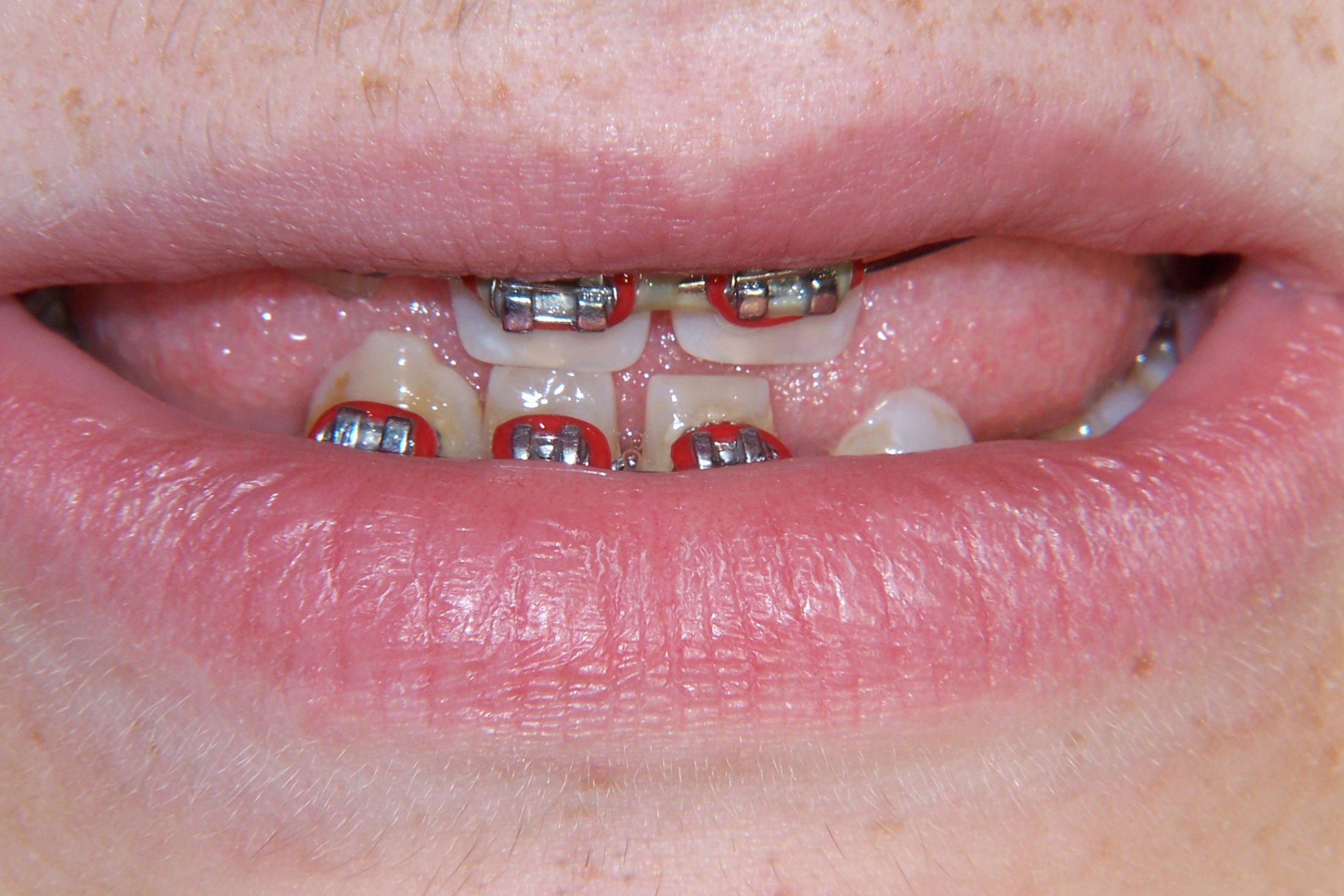 A crooked smile with gaps between teeth shown in the process of having their teeth straightened by braces