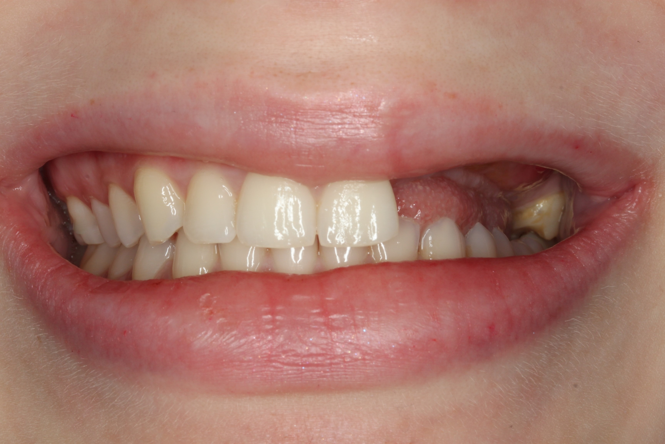 A patient's mouth with most of the teeth missing from the maxillary left quadrant