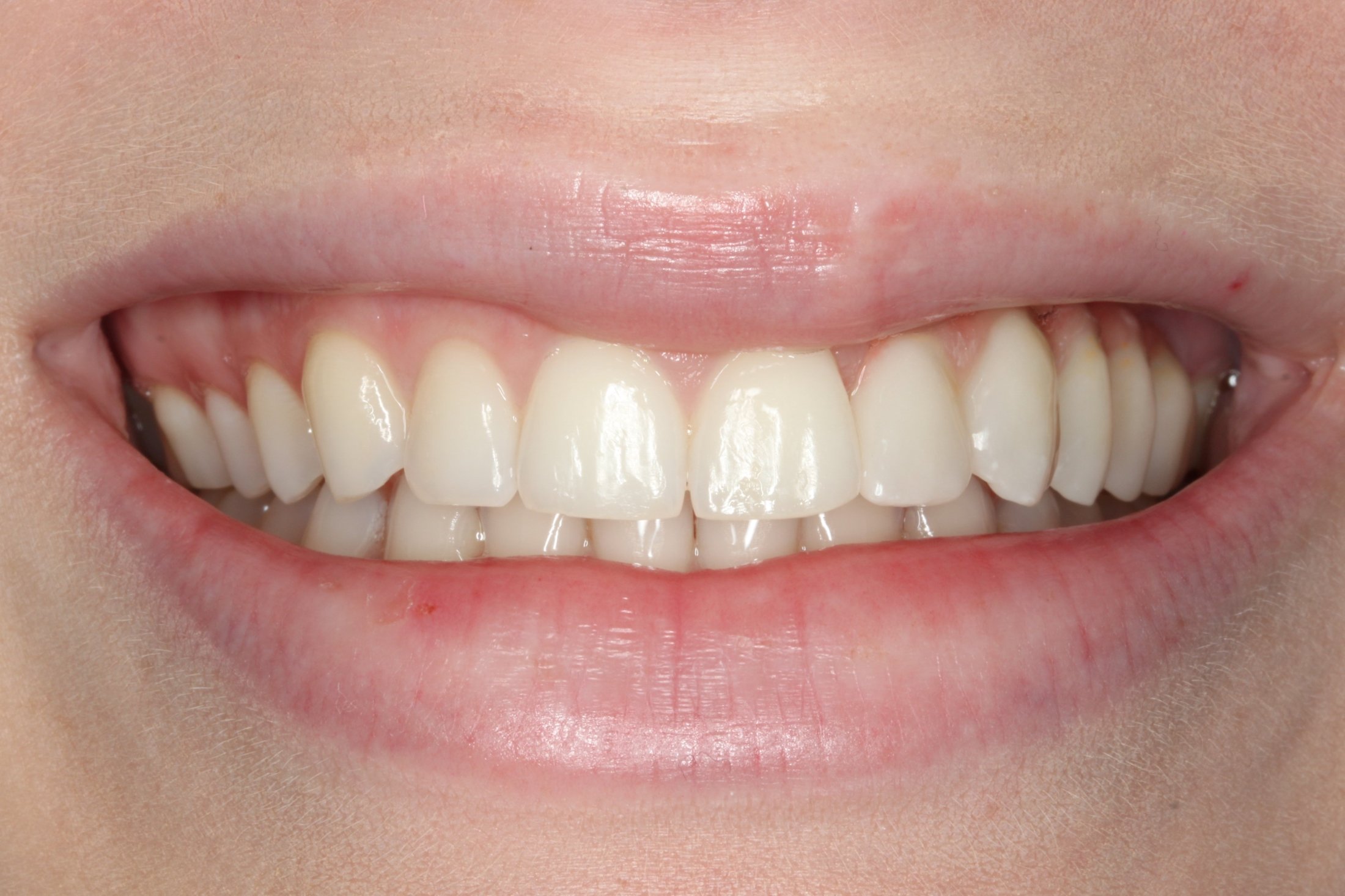 A patient's mouth after Implant Supported Fixed Prosthesis has replaced the teeth in their maxillary left quadrant